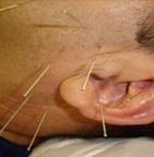 anxiety acupuncture houston